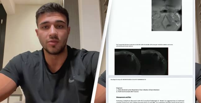 Tommy Fury Injury Proof For Jake Paul Fight - Tommy Fury/Instagram